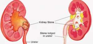 علاج حصى الحالب