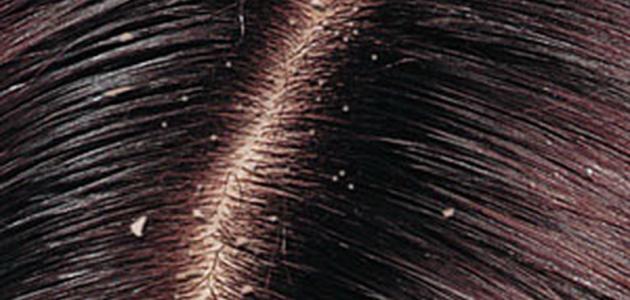 كيف ينتقل القمل والصيبان