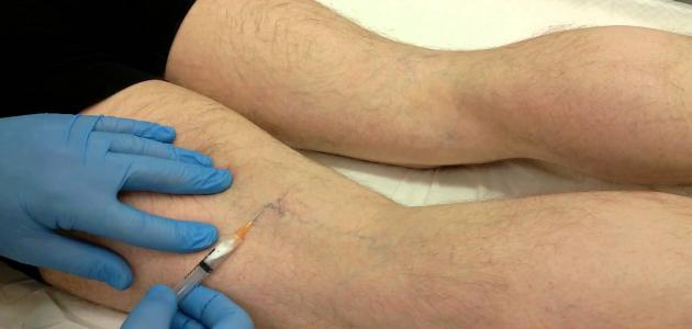 كيفية علاج الدوالي