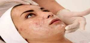 أسباب حبوب الوجه