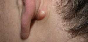 ظهور ورم تحت الأذن