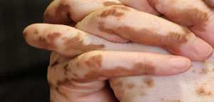 الفرق بين البرص والبهاق