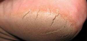 كيفية علاج تشقق القدمين