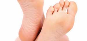 طرق لعلاج تشقق القدمين