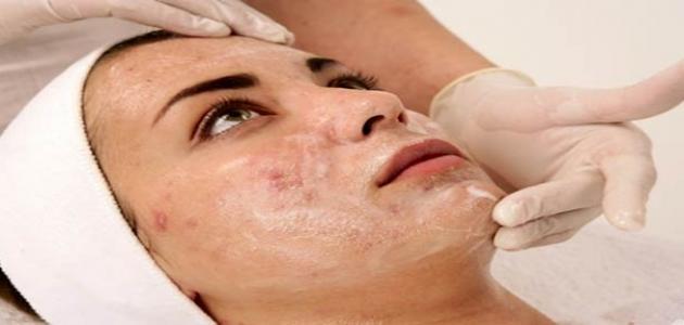 أسباب حبوب الوجه