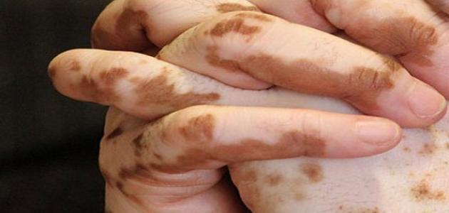 الفرق بين البرص والبهاق