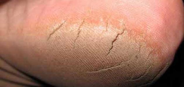 كيفية علاج تشقق القدمين