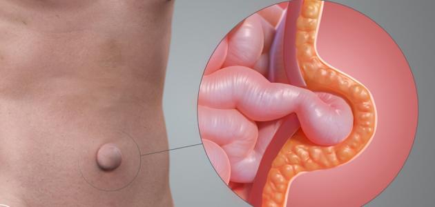 الفتق - فيديو