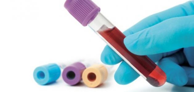 أضرار نقص الكالسيوم وفيتامين د