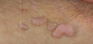 علاج الثواليل