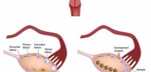 علاج التكيس