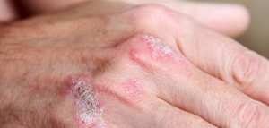 علاج الصدفية بالاعشاب