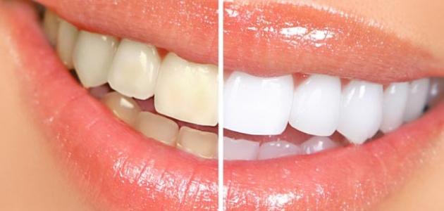 كيفية تبييض الأسنان