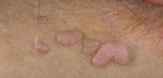 علاج الثواليل