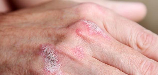 علاج الصدفية بالاعشاب