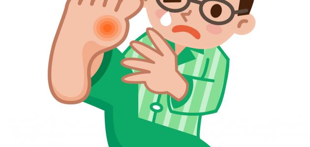 علاج النقرس بالاعشاب