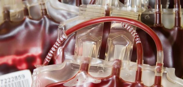 أسباب فقر الدم بعوز الحديد