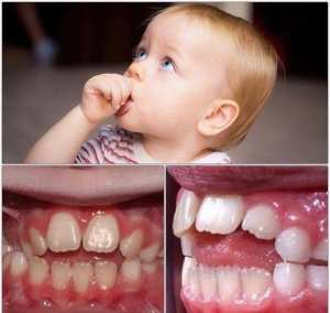 مص الطفل لاصبعه و تأثيرها علي الاسنان