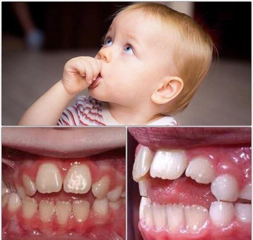 مص الطفل لاصبعه و تأثيرها علي الاسنان