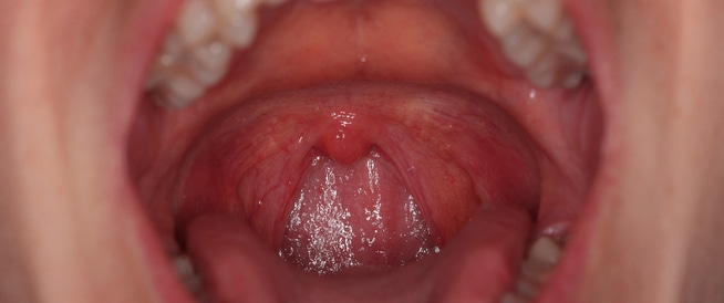 علاج التهاب اللوزتين وعدم استصائلهما