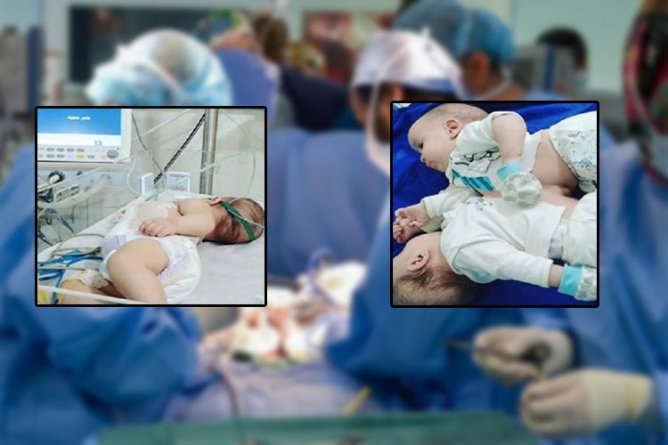 نهاية مأساة التوأمين الملتصقين بالجزائر