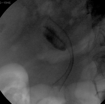 CPRE avec Prothèse biliaire pour cancer du pancréas