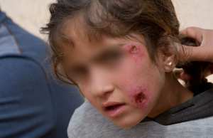 Tébessa - 1.700 cas de leishmaniose cutanée enregistrés en 2020 dans les zones isolées