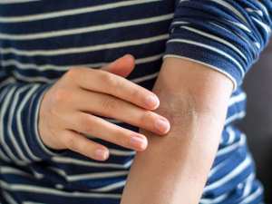 10 conseils anti-eczéma