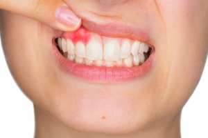 Gencives et inflammation