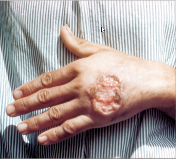 Lutte contre la leishmaniose