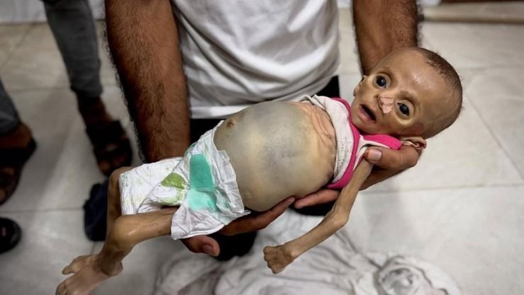 منظمة الصحة العالمية تدق ناقوس الخطر بشأن سوء التغذية في غزة