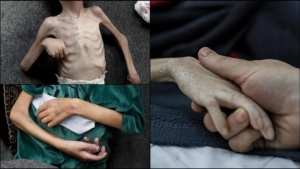 مدير الإغاثة الطبية بغزة: 17 ألف طفل يعانون من سوء تغذية حاد