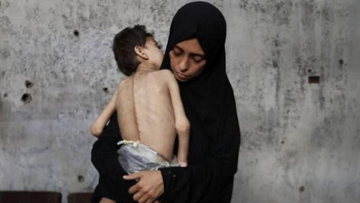 6 وفيات جديدة في غزة بسبب المجاعة وسوء التغذية