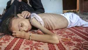 وزارة الصحة الفلسطينية: 5 وفيات جديدة بسبب المجاعة وسوء التغذية في غزة