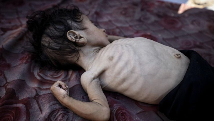 ارتفاع ضحايا المجاعة وسوء التغذية في غزة إلى 212 حالة وفاة