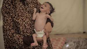 غزة.. ارتفاع وفيات التجويع إلى 251 بينهم 108 أطفال