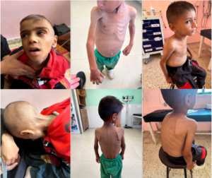 Le bilan de la famine et  de la malnutrition s'alourdit