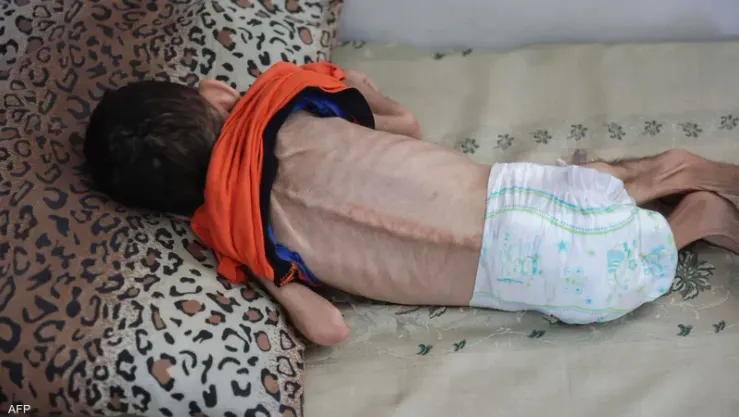 غزة: 8 وفيات بينهم 3 أطفال خلال الـ24 ساعة الماضية بسبب المجاعة