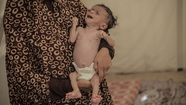 غزة.. ارتفاع وفيات التجويع إلى 251 بينهم 108 أطفال