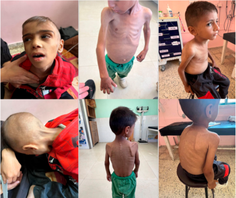 Le bilan de la famine et  de la malnutrition s'alourdit