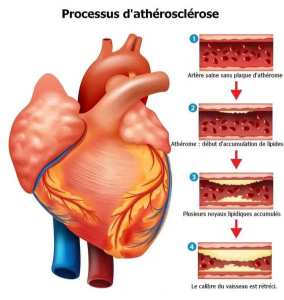 le processus d'athérosclérose