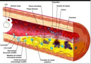 Athérosclérose : (comprendre la maladie en 1 minute)
