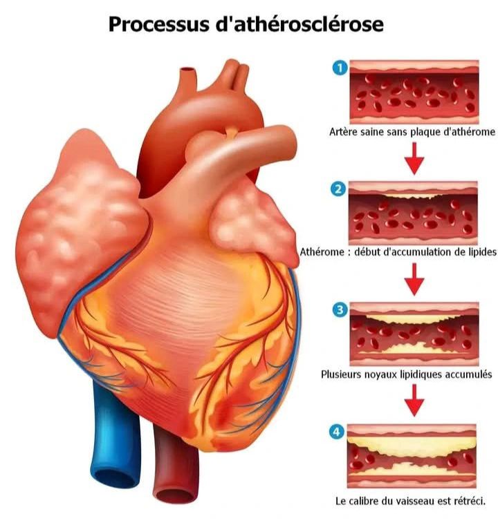 le processus d'athérosclérose