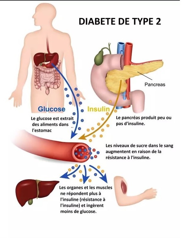 Diabète : (comprendre la maladie en 1 minute)
