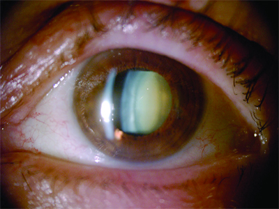 100 000 nouveaux cas par an en Algérie