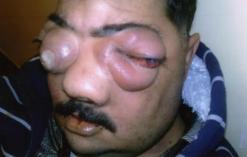 رب عائلة يستنجد لإنقاذه من مرض خبيث ينهش وجهه                                    ميلة