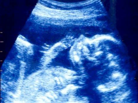 L'importance de l'échographie pour détecter les anomalies                                    Malformations f'tales en Algérie