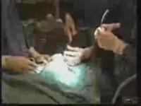 Setif - Traitement du kyste hydatique du foie par coelioscopie:  Une première à l'est du pays