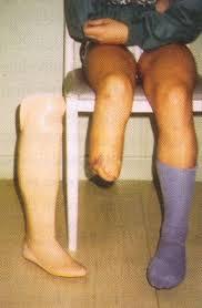 Oran - Près de 1.500 amputations de pieds de diabétiques en 2013: La prise en charge d'un seul malade coûte 3.000 euros au CHUO