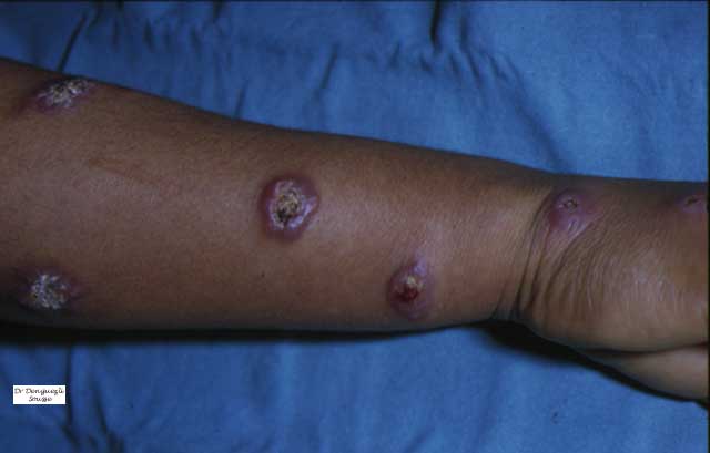 Biskra -  La leishmaniose sévit à Aïn Naga